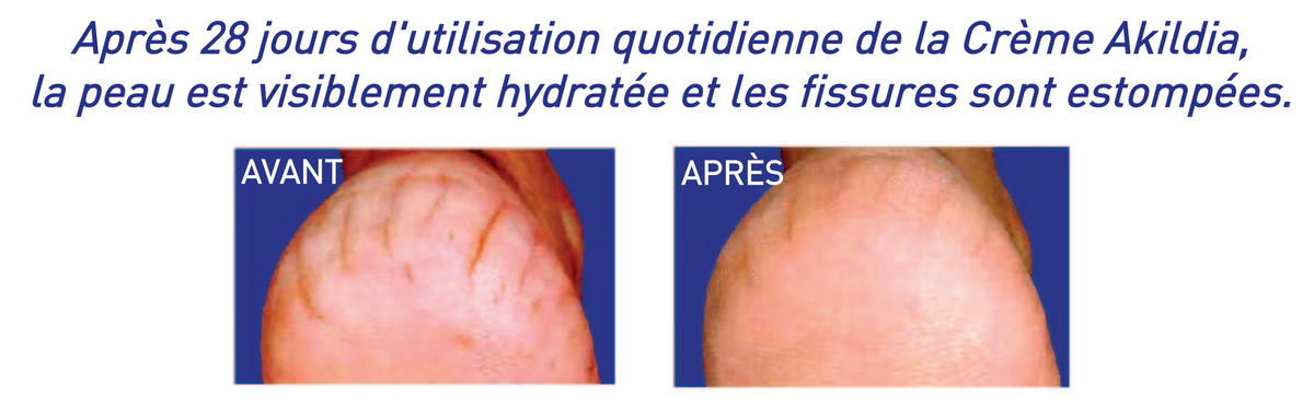 AKILDIA, la crème multi-protectrice d’Akileïne